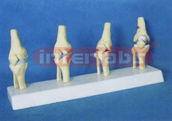 MIDDLE ADULT KNEE JOINTS SYNTHESIS MODEL FOR HEALT COMPARE WITH DISEASES (COLLE CTION 4 PCS/SET)  i.e. A TYPE, D TYPE, B TYPE & E TYPE